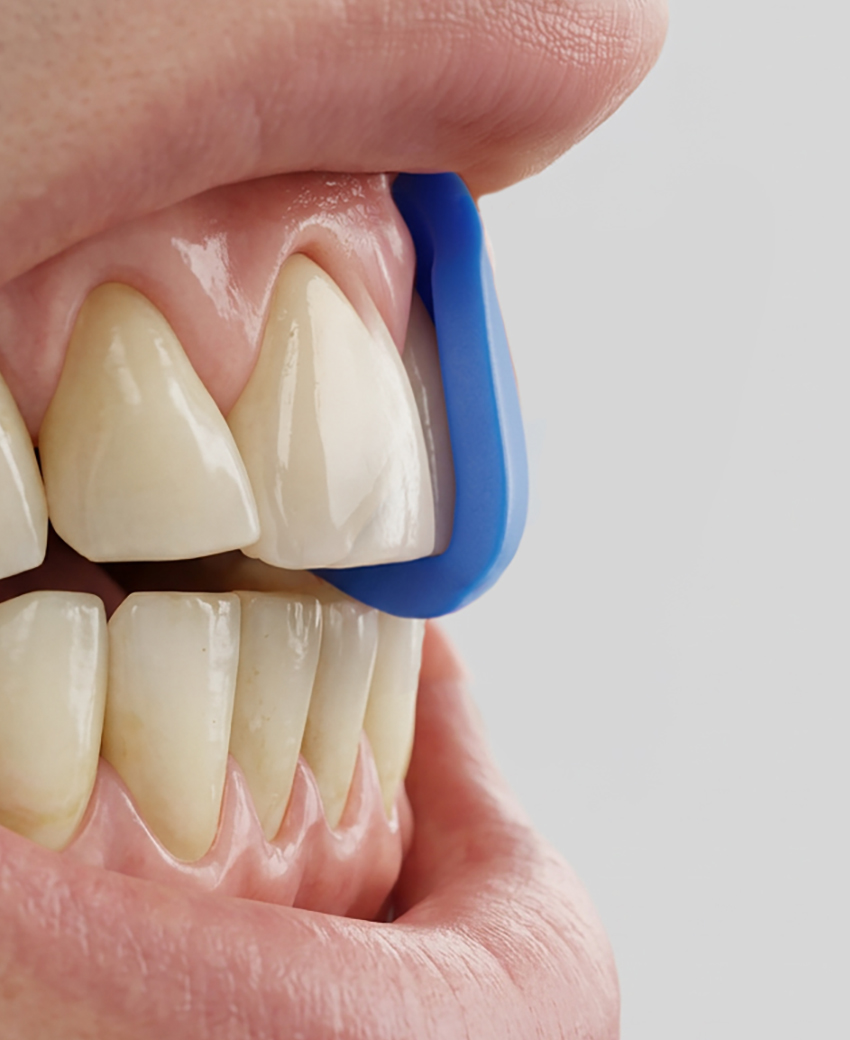 Protetor bucal personalizado GuardX Active aplicado aos dentes