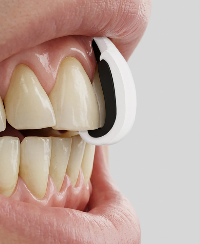 Protetor bucal personalizado GuardX Impact aplicado aos dentes